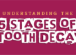 tooth decay stages