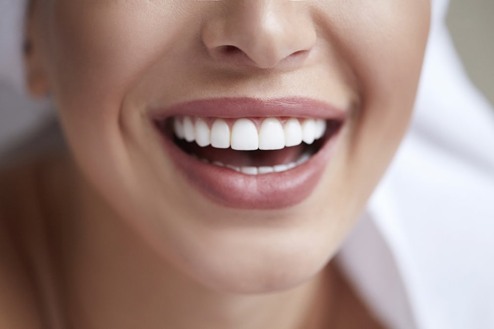 Porcelain veneers recreate the natural look of teeth